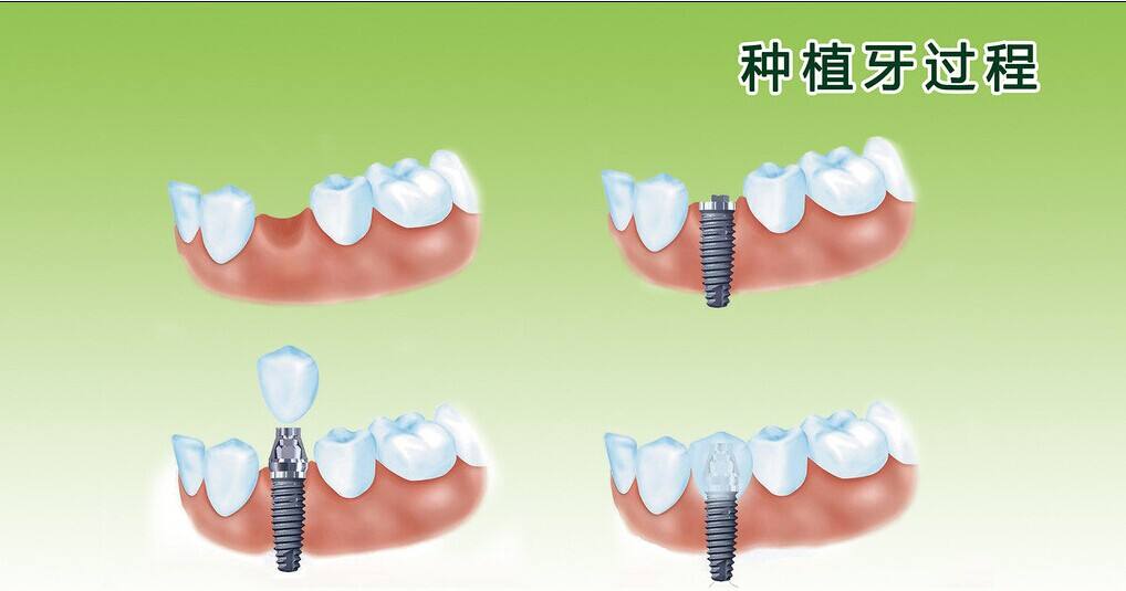 种牙