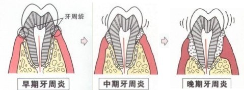 牙周炎的临床表现有哪些
